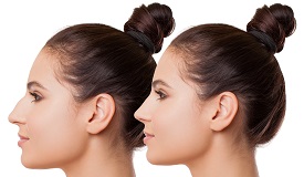 closed-rhinoplasty